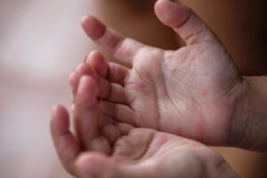 Kinderkrankheiten Hand-Fuß-Mund-Krankheit